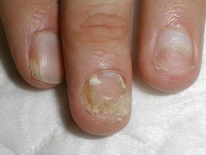 liječenje gljivice na noktima candida