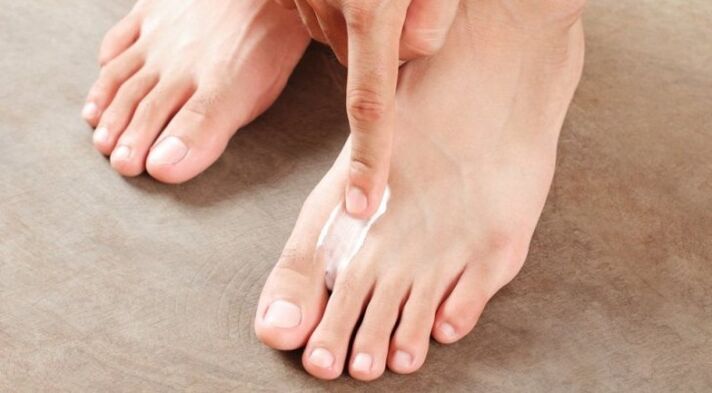 kako i kako liječiti gljivicu između prstiju na nogama