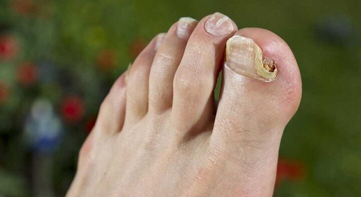 oštećenje ploče nokta gljivicama na nogama