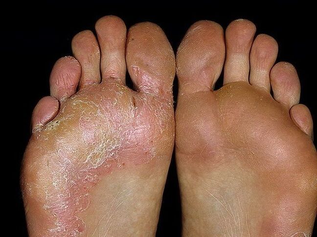 simptomi gljivice na stopalu