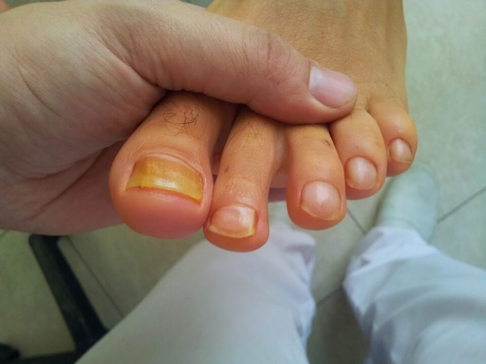 žutilo noktiju na nogama s gljivicom