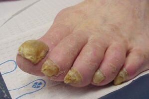 simptomi gljivica noktiju na nogama
