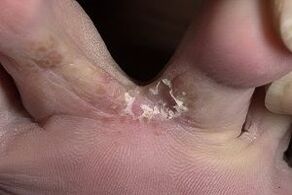 gljivice na koži između nožnih prstiju