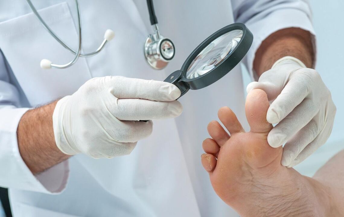 liječnik pregleda stopala s gljivicom
