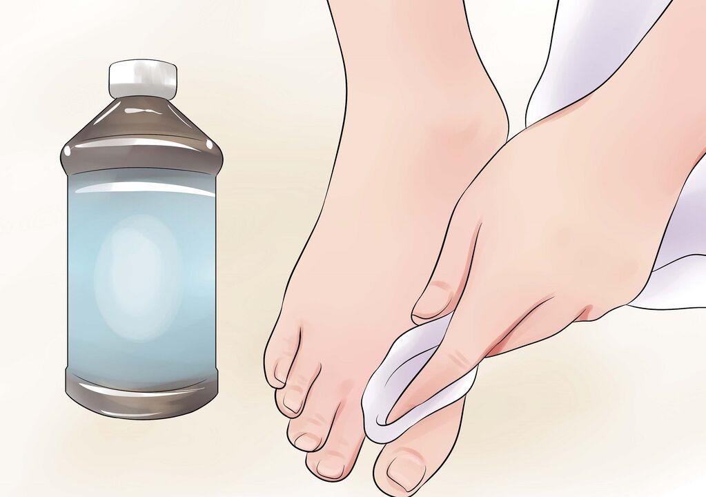 vodikov peroksid za gljivice noktiju na nogama