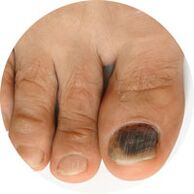 kako liječiti gljivice noktiju na nogama