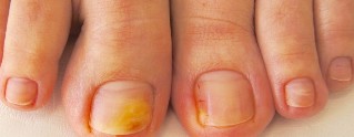 gljiva noktiju na nogama simptomi
