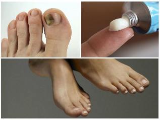 gljiva noktiju na nogama tretman