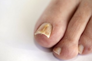 gljiva noktiju na nogama