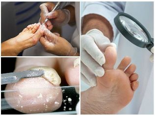 gljiva kože nogu dijagnostika