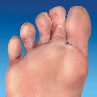 gljiva kože stopala