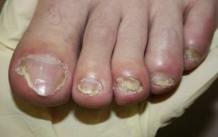 simptomi gljivica noktiju